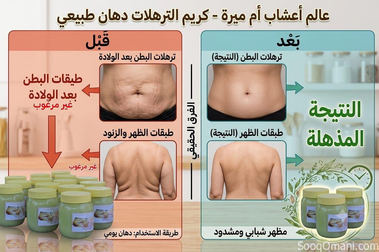 كريم شفط الدهون